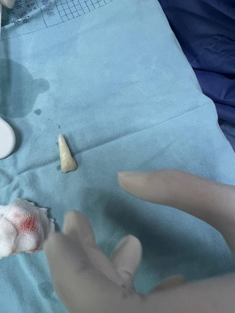 陈姓学童脸部重摔著地,门牙连根掉落。(图由陈童家长提供) 陈姓学童脸部重摔著地,门牙连根掉落。(图由陈童家长提供)
