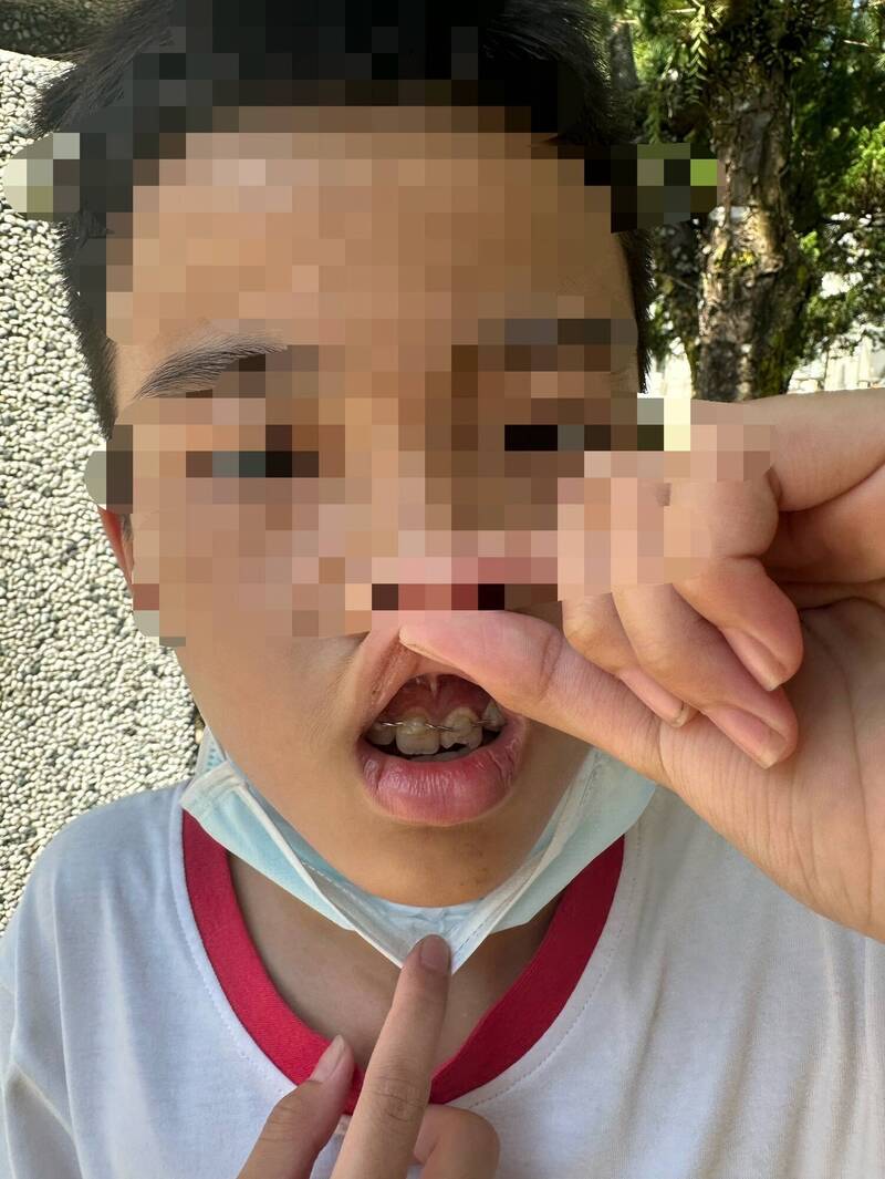 男童的门牙虽放回再以金属线固定,但未来仍须植牙补救,目前日常生活也大受影响。(图由陈童家长提供) 男童的门牙虽放回再以金属线固定,但未来仍须植牙补救,目前日常生活也大受影响。(图由陈童家长提供)